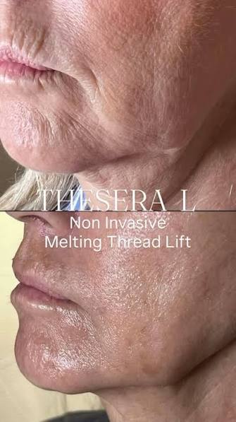 THESERA L Liquid Thread Lift before and after treatment result