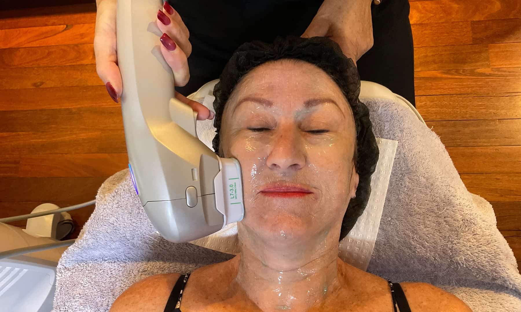 HIFU treatment being performed at Dermal Beauty