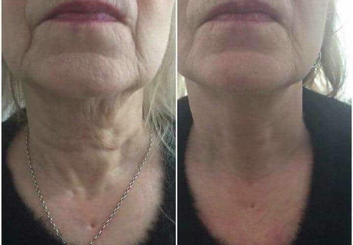 Before and after HIFU neck and lower face result reference