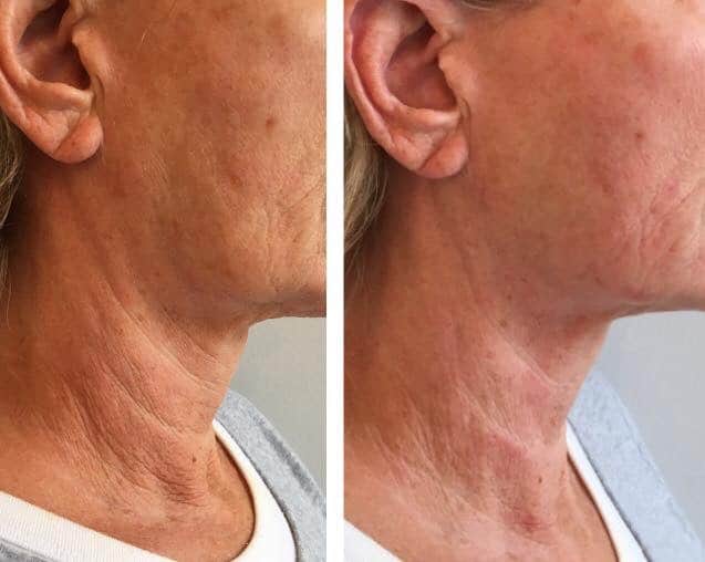 Before and after HIFU facial contour result reference