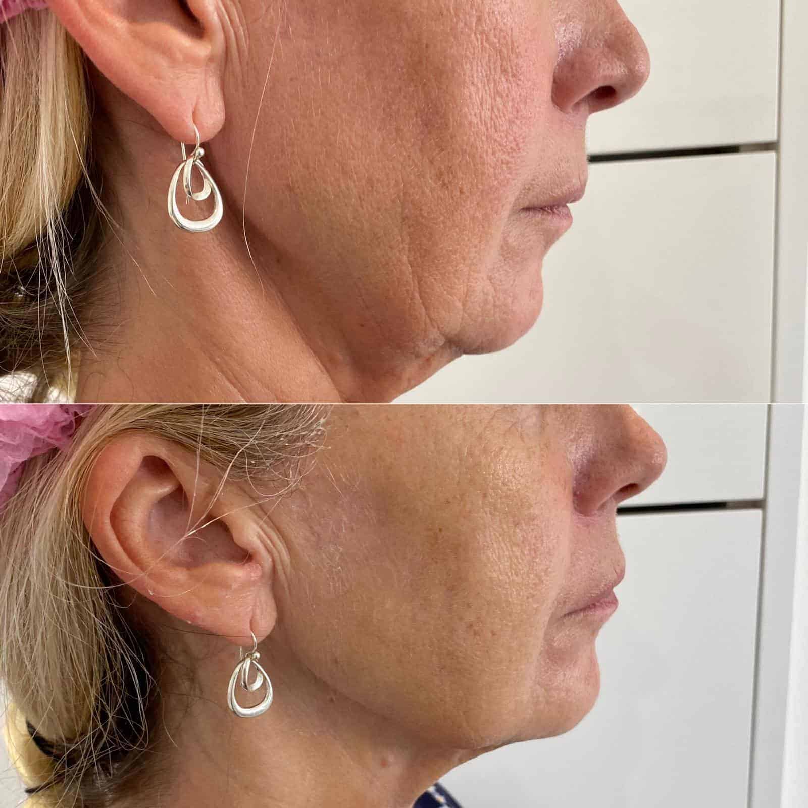 Before and after HIFU jawline result reference
