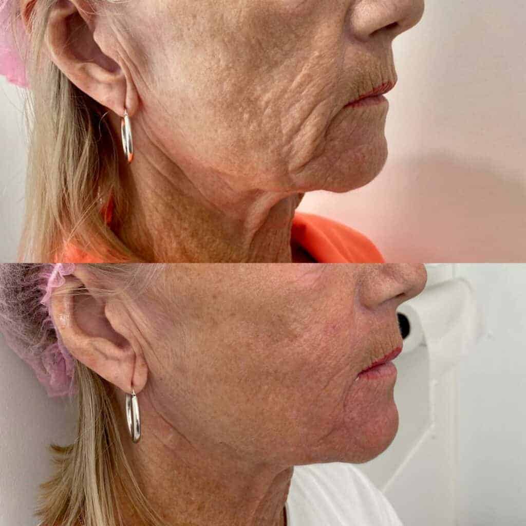 Before and after HIFU facial result reference
