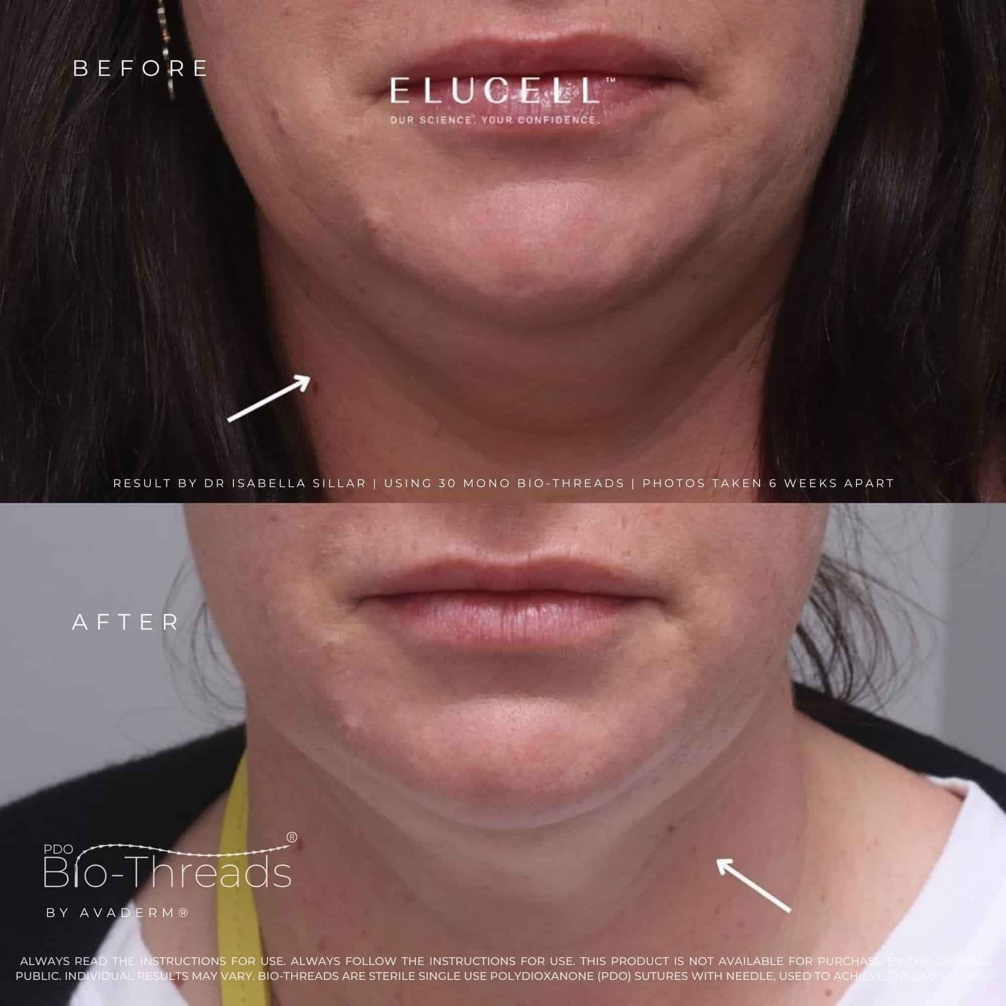 Jawline treatment result reference