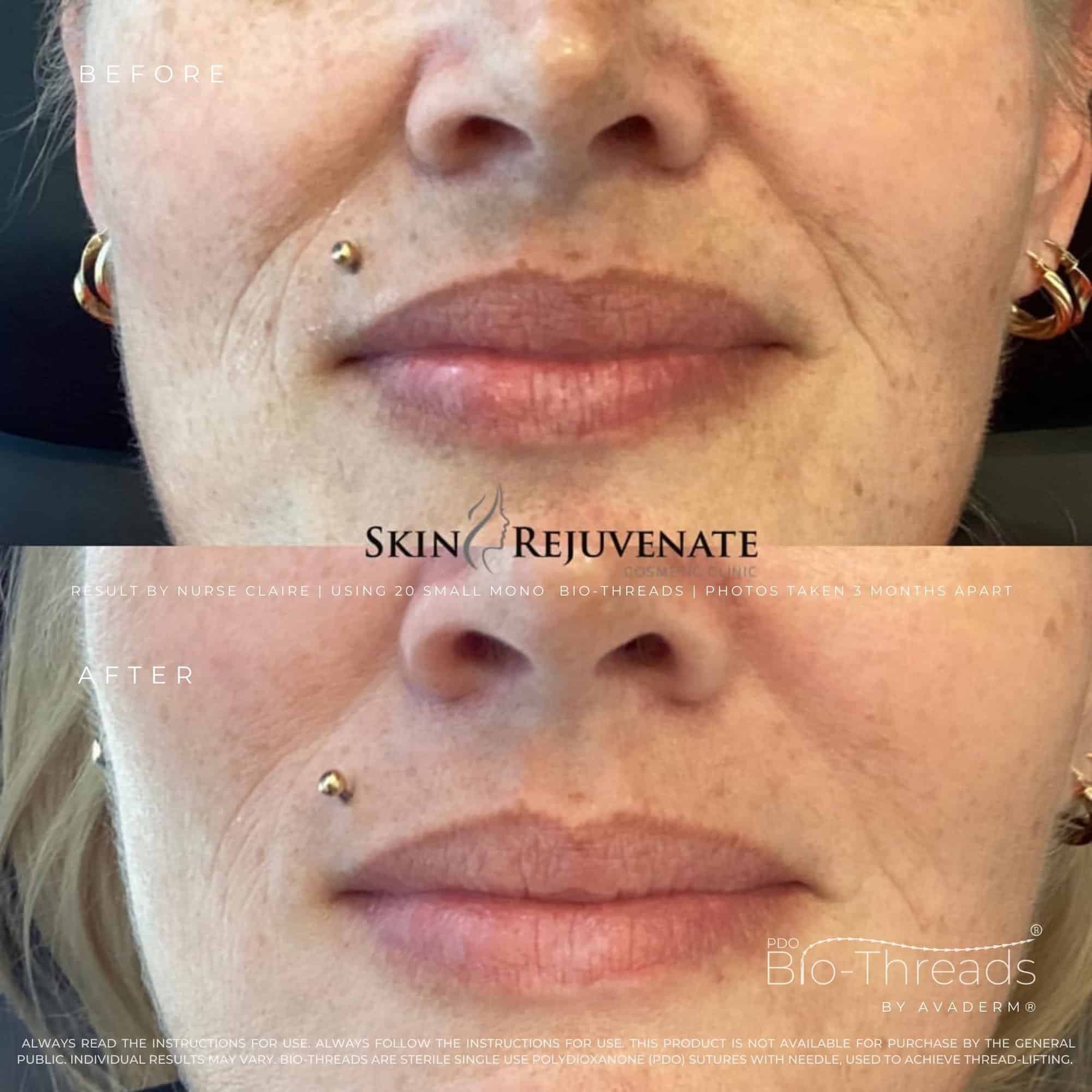 Skin line treatment result reference