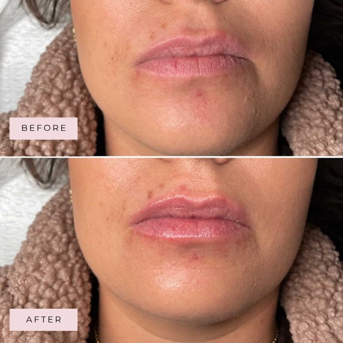 LIP LUXE before and after result