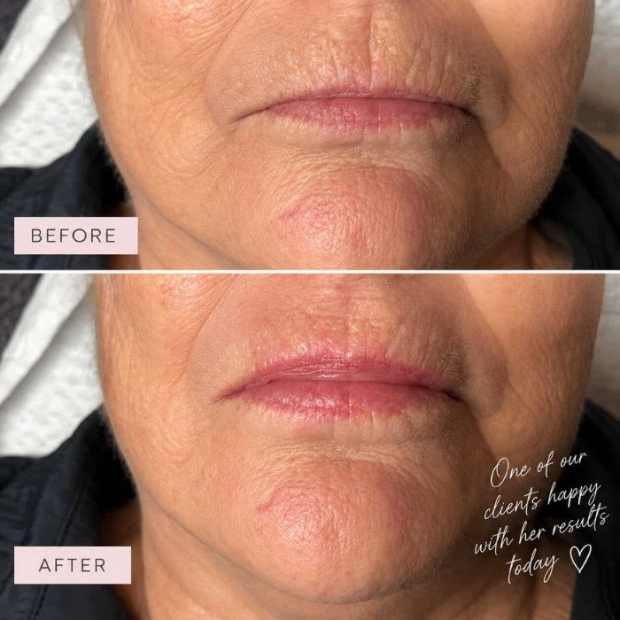 Lip definition before and after