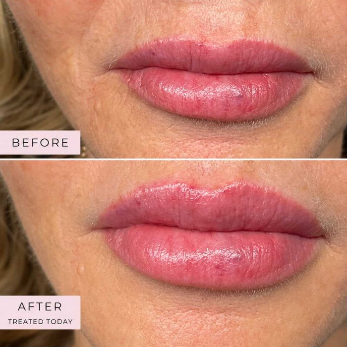Lip hydration and fullness before and after